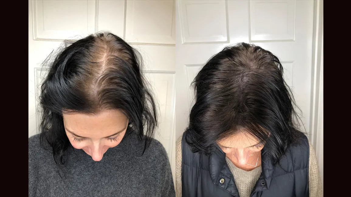 Scalp Micropigmentation Service
