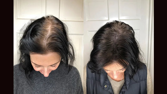 Scalp Micropigmentation Service